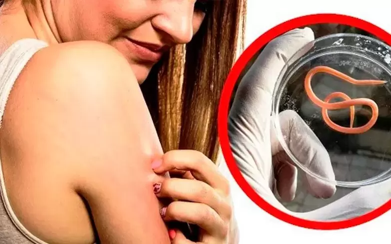 azkura eta narritadura parasitoen ondorioz gorputzean