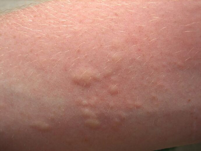 larruazaleko erupzio alergiko azkurak ascariasisaren sintomak izan daitezke